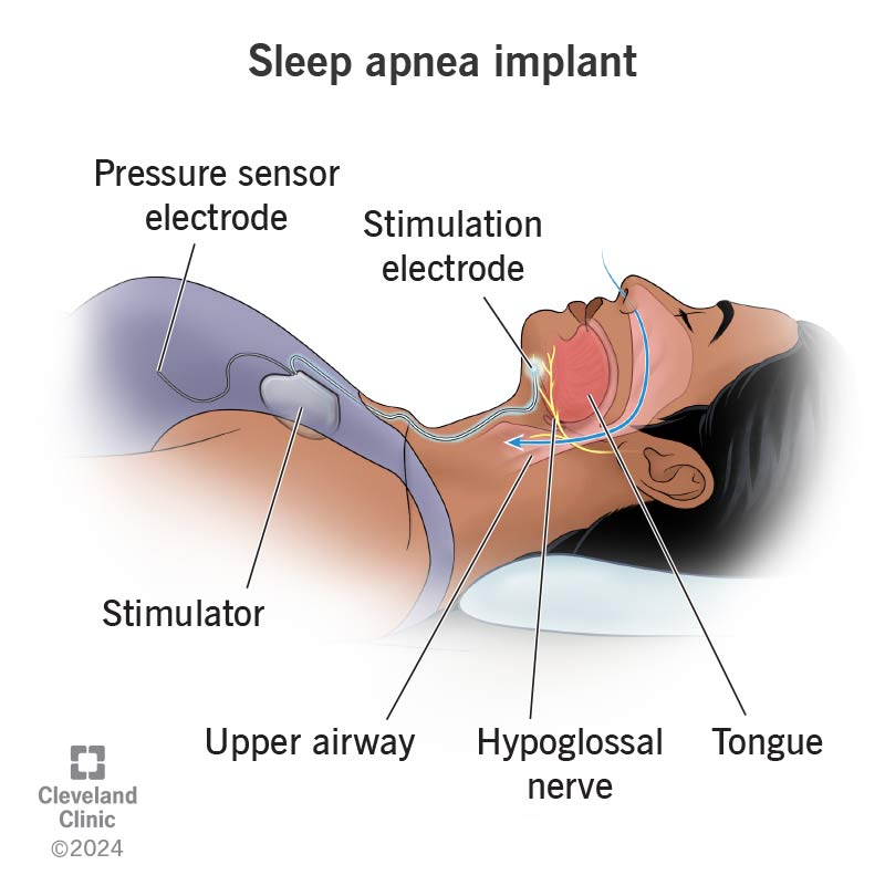 Inspire Implant Diagram