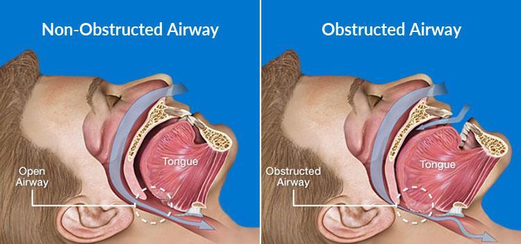 Obstructive sleep apnea airway diagram