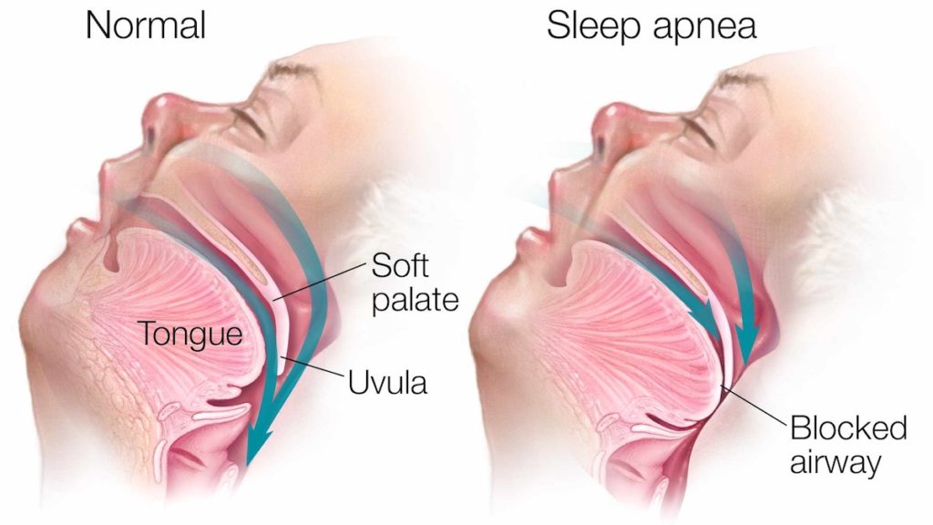 Normal vs sleep apnea airway comparison showing obstruction