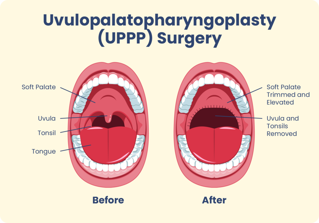 UPPP Surgery Illustration